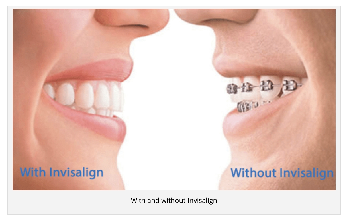 Invisalign Invisible Braces Before & After Photos